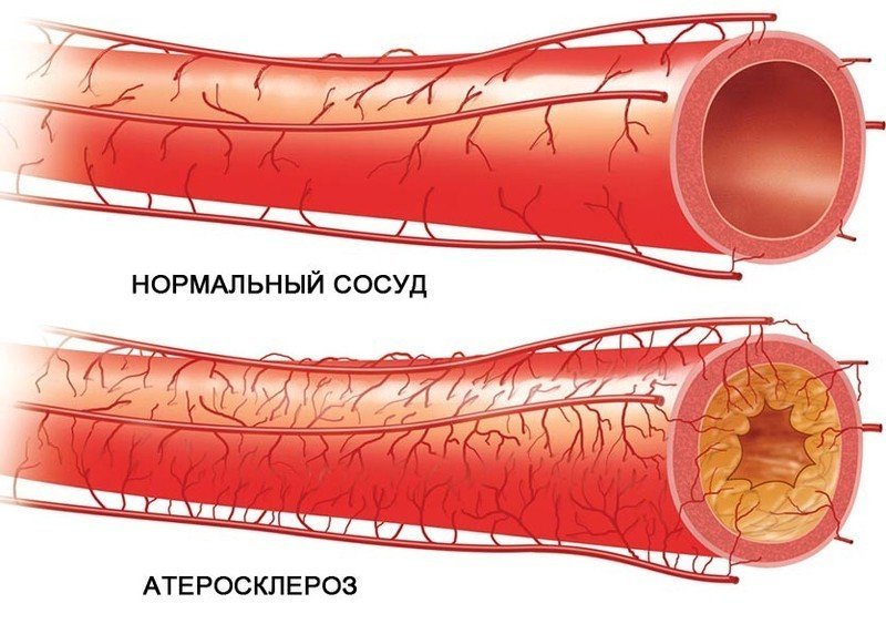 Атеросклероз аорты и сосудов